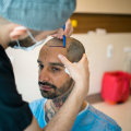 Does the Hair Transplant Clinic Accommodate International Patients?