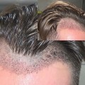 Can Transplanted Hair Fall Out After Years? - An Expert's Perspective