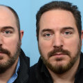 The Difference Between Hair Transplant and Hair Replacement: An Expert's Perspective