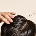 Non-Surgical Alternatives to Hair Transplant Surgery: A Comprehensive Guide