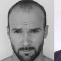 Does Hair Transplant Last for 10 Years? - An Expert's Perspective