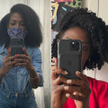 The Best Hair Transplant for African American Hair: SmartGraft FUE