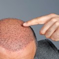 Does the Hair Transplant Clinic Staff Have the Expertise to Handle Different Surgical Instruments and Tools?