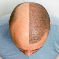 What Aftercare Should You Expect from a Hair Transplant Clinic?