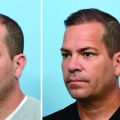 The Most Advanced Hair Transplant Technique: NeoGraft - A Comprehensive Guide