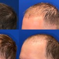 Does Transplanted Hair Fall Out After 2 Years?