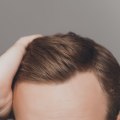 Does Hair Transplant Clinic Provide Pre-Procedure Counseling or Advice?