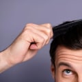Everything You Need to Know Before Getting a Hair Transplant