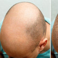 What Makes a Great Hair Transplant Surgeon? - An Expert's Perspective