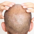 What Kind of Follow-Up Care is Provided After a Hair Transplant?