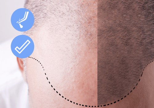 The Role of Staff at a Hair Transplant Clinic: What You Need to Know