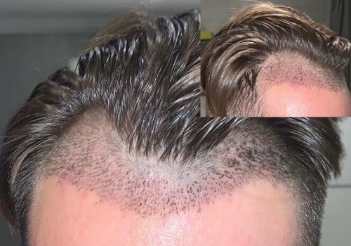 What Happens to Hair Transplant Results as You Age?