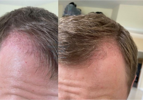 A Comprehensive Guide to Hair Transplant Progress: What to Expect