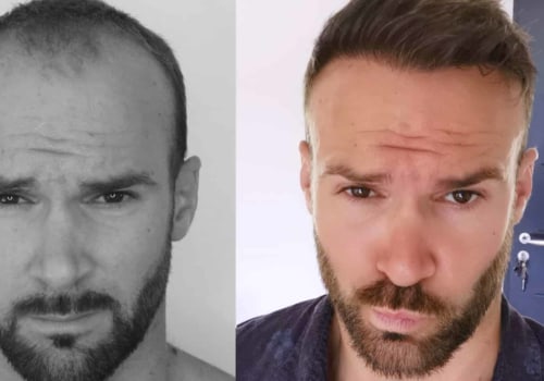 Does Hair Transplant Last for 10 Years? - An Expert's Perspective