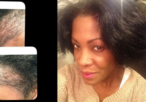 Do Hair Transplants Work for Black People? A Comprehensive Guide