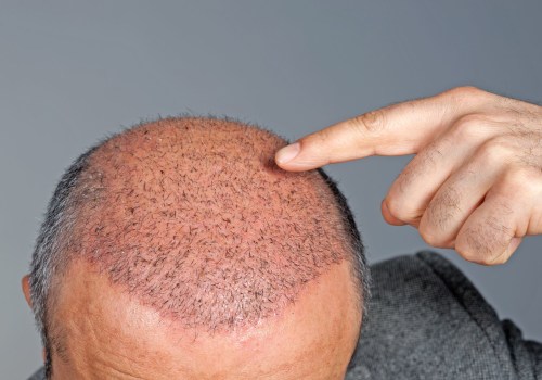 Does the Hair Transplant Clinic Staff Have the Expertise to Handle Different Surgical Instruments and Tools?