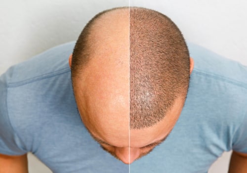 Affordable Hair Transplant Solutions: Financing and Payment Options Explained