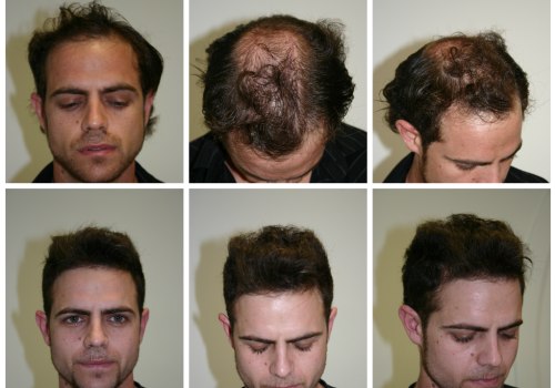 10 Tips for Choosing the Right Hair Transplant Clinic