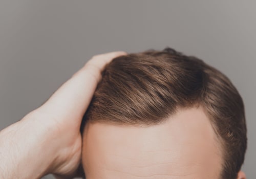 Does Hair Transplant Clinic Provide Pre-Procedure Counseling or Advice?