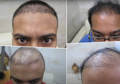 How Much Experience Does a Hair Transplant Clinic Staff Have?