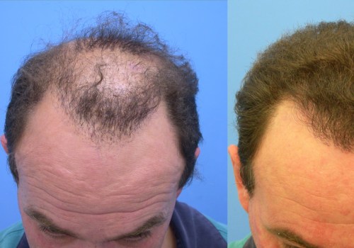 The Best Hair Transplant Solutions in Nashville: Get the Look You Deserve
