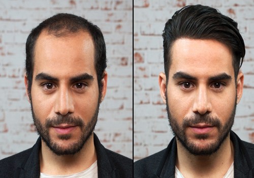 What Makes a Great Hair Transplant Clinic? - An Expert's Guide